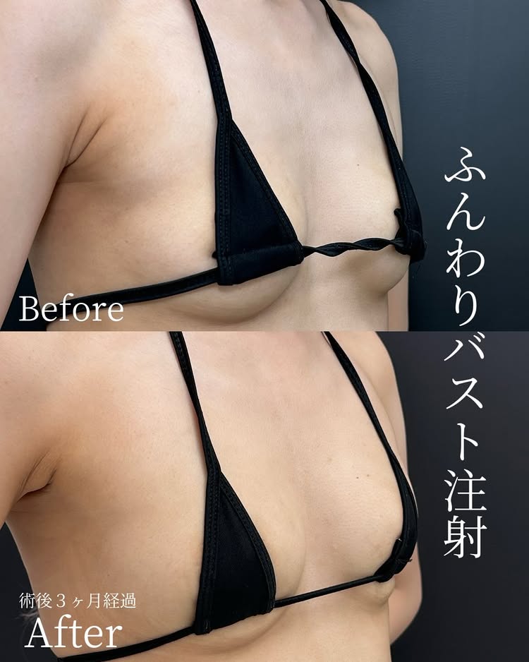 ふんわりバスト注射の症例写真 (1)