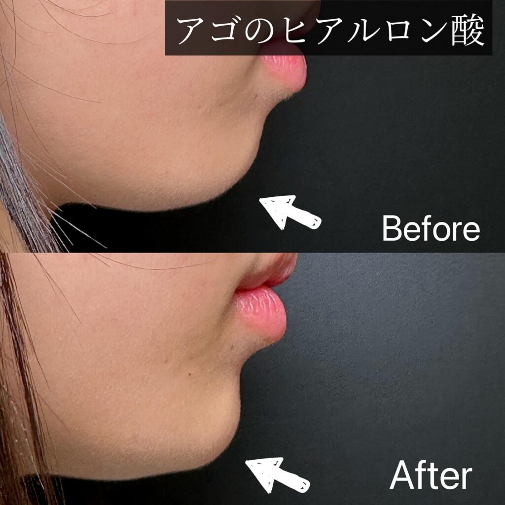 顎のヒアルロン酸の症例写真 (5)