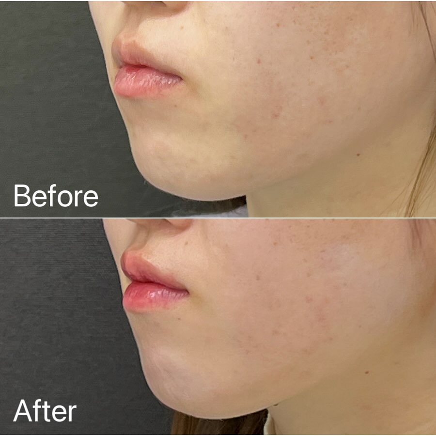 唇のヒアルロン酸の症例写真 (17)