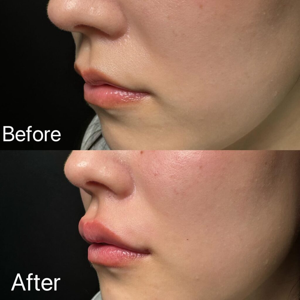 唇のヒアルロン酸 (2)