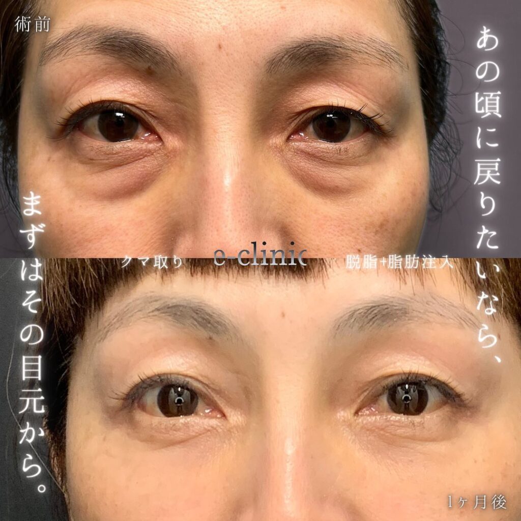 脱脂と脂肪注入の症例写真 (4)