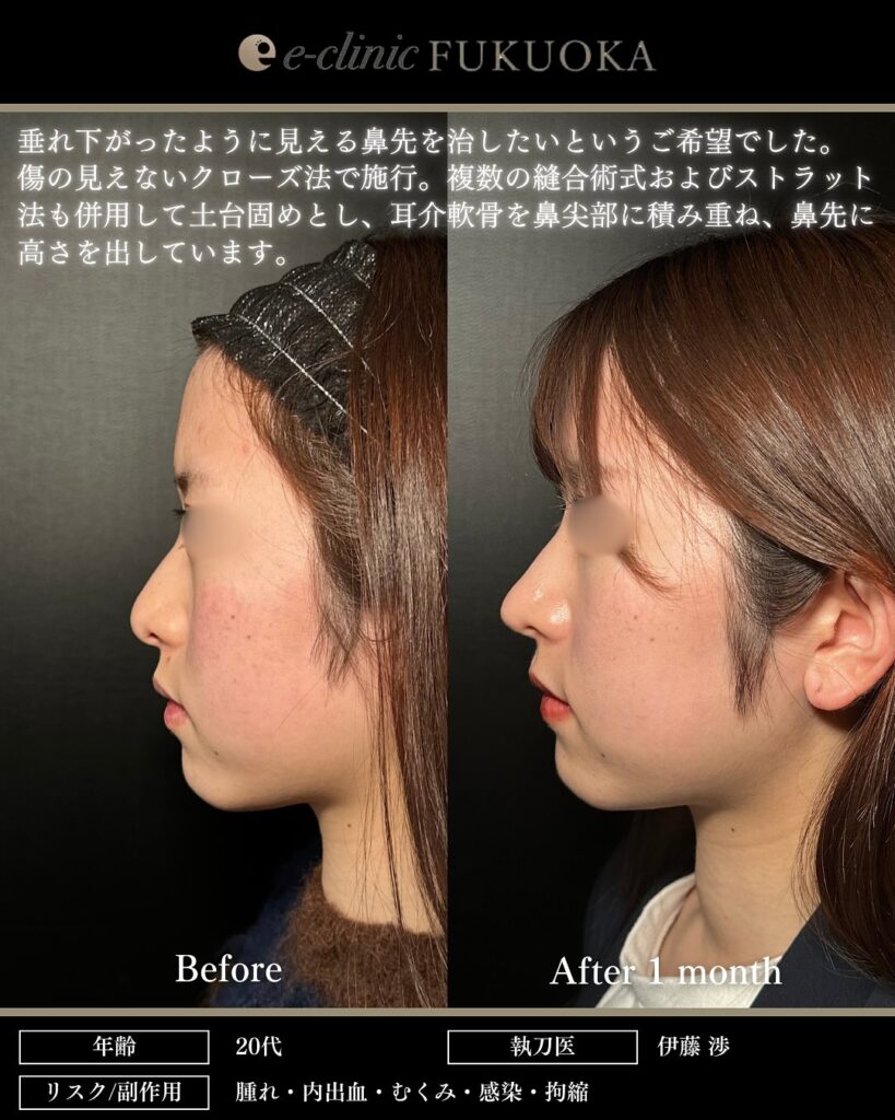 鼻尖形成と軟骨移植の症例写真 (32)