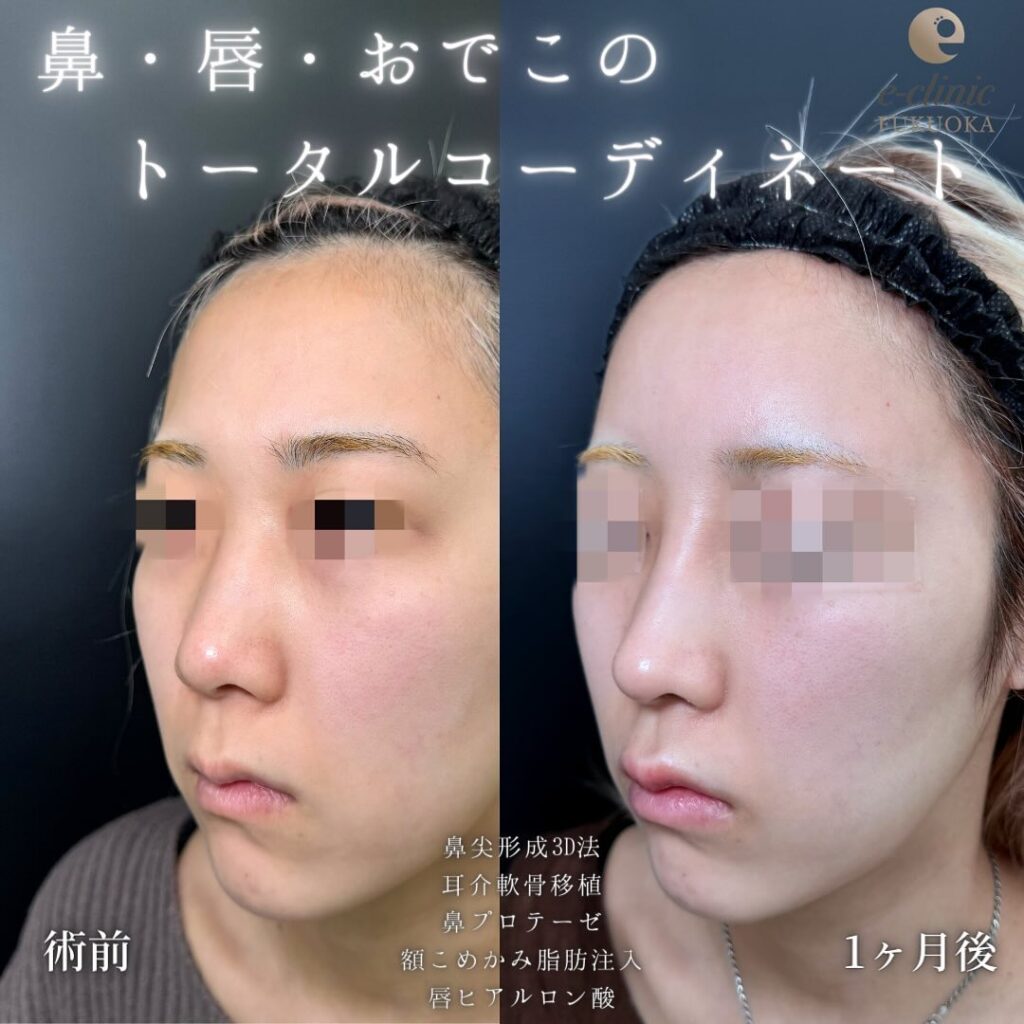 鼻尖形成と軟骨移植とプロテーゼと額とこめかみの脂肪注入と唇のヒアルロン酸の症例写真 (1)
