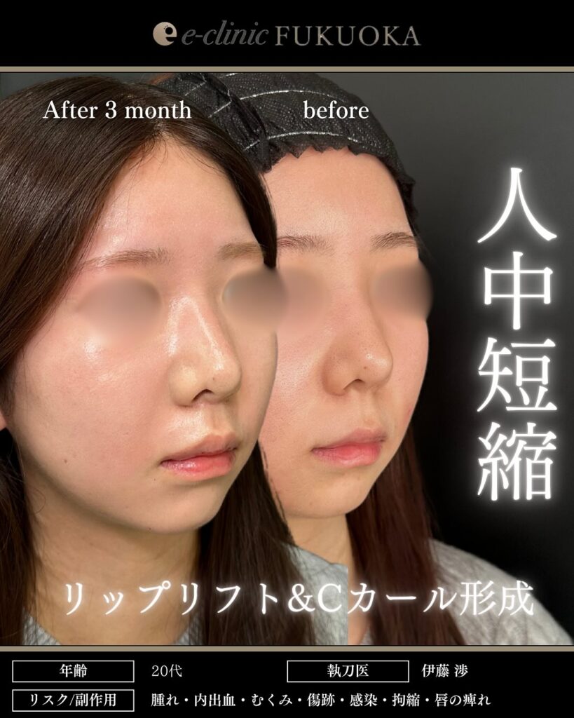 人中短縮の症例写真 (12)