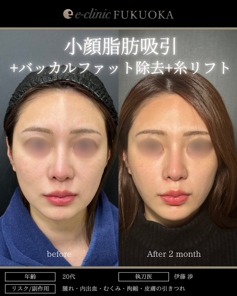 頬と顎下の脂肪吸引とジョールファットとバッカルファットと糸リフトの症例写真 (1)