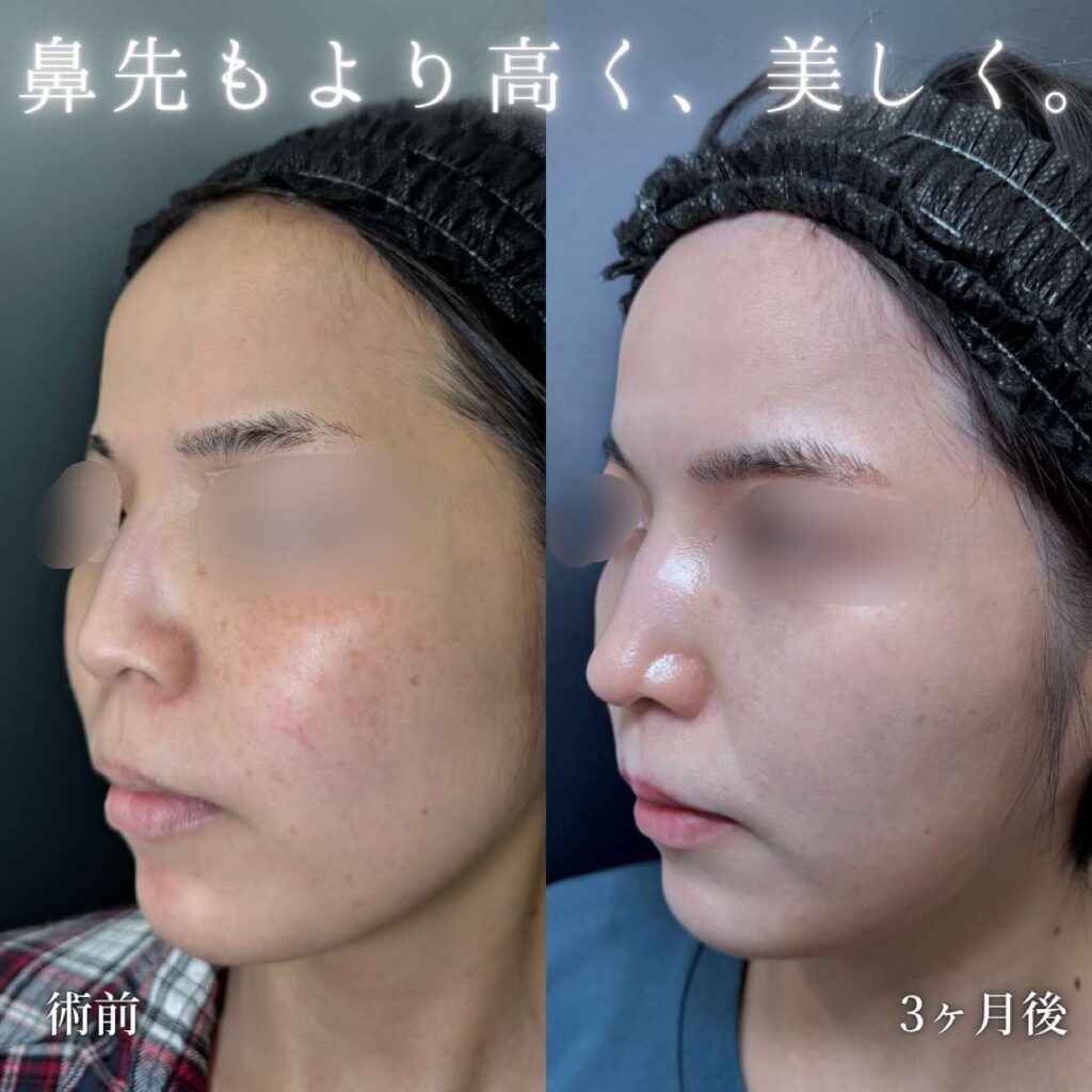 鼻尖形成と軟骨移植と鼻柱下降と小鼻縮小の症例写真 (6)