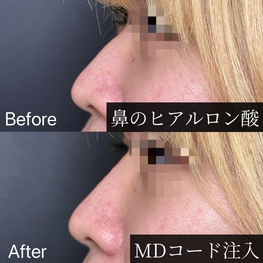 鼻のヒアルロン酸の症例写真 (3)