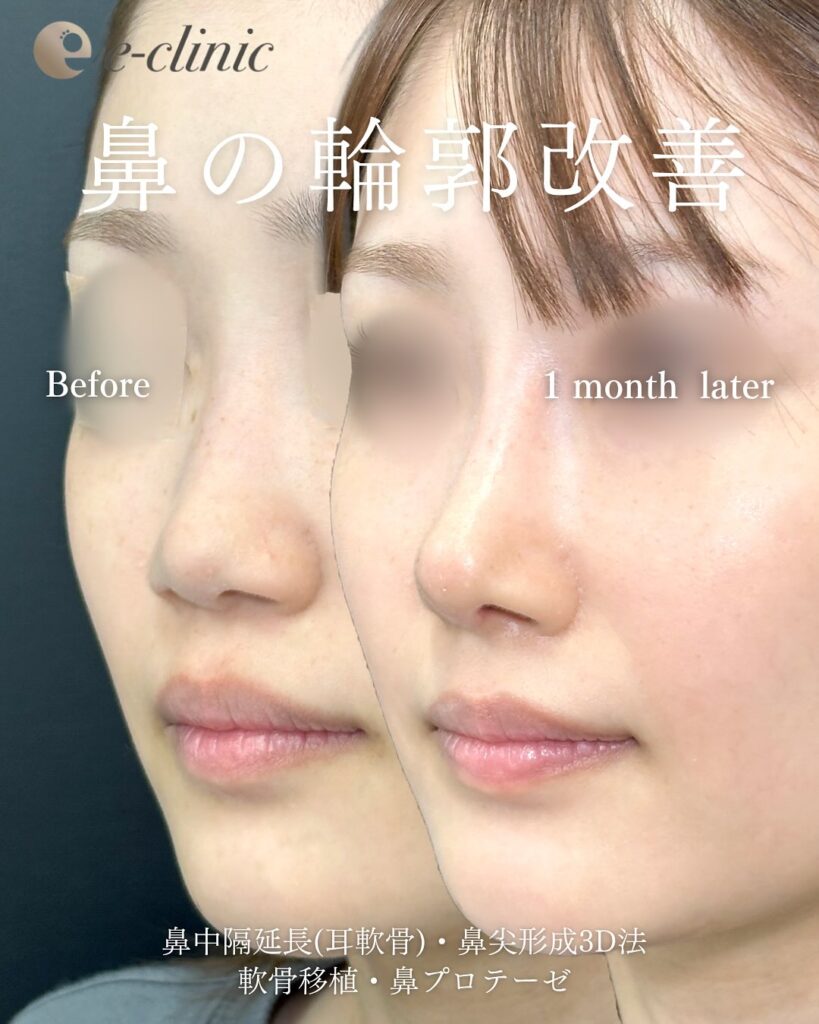 鼻中隔延長と鼻尖形成と軟骨移植とプロテーゼの症例写真 (1)