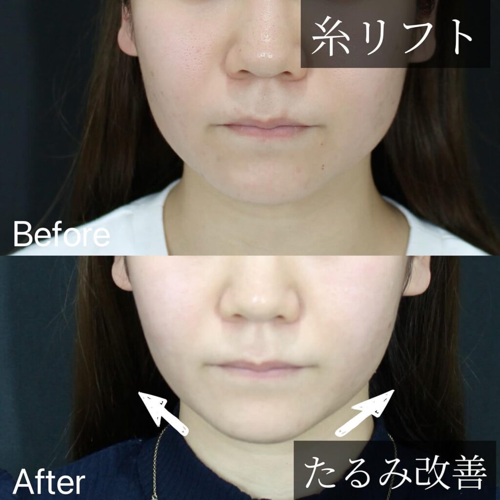 糸リフトの症例写真 (12)