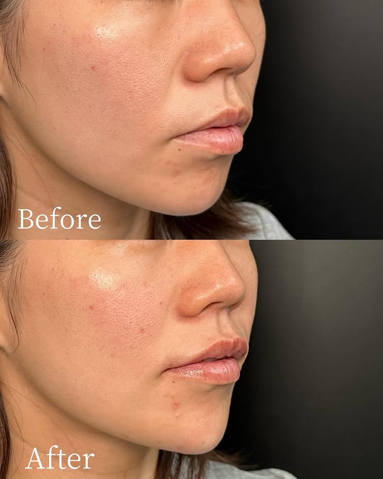 唇のヒアルロン酸の症例写真 (55)