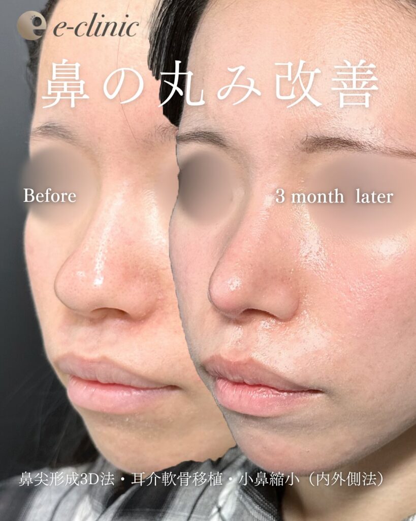鼻尖形成と軟骨移植と小鼻縮小の症例写真 (41)