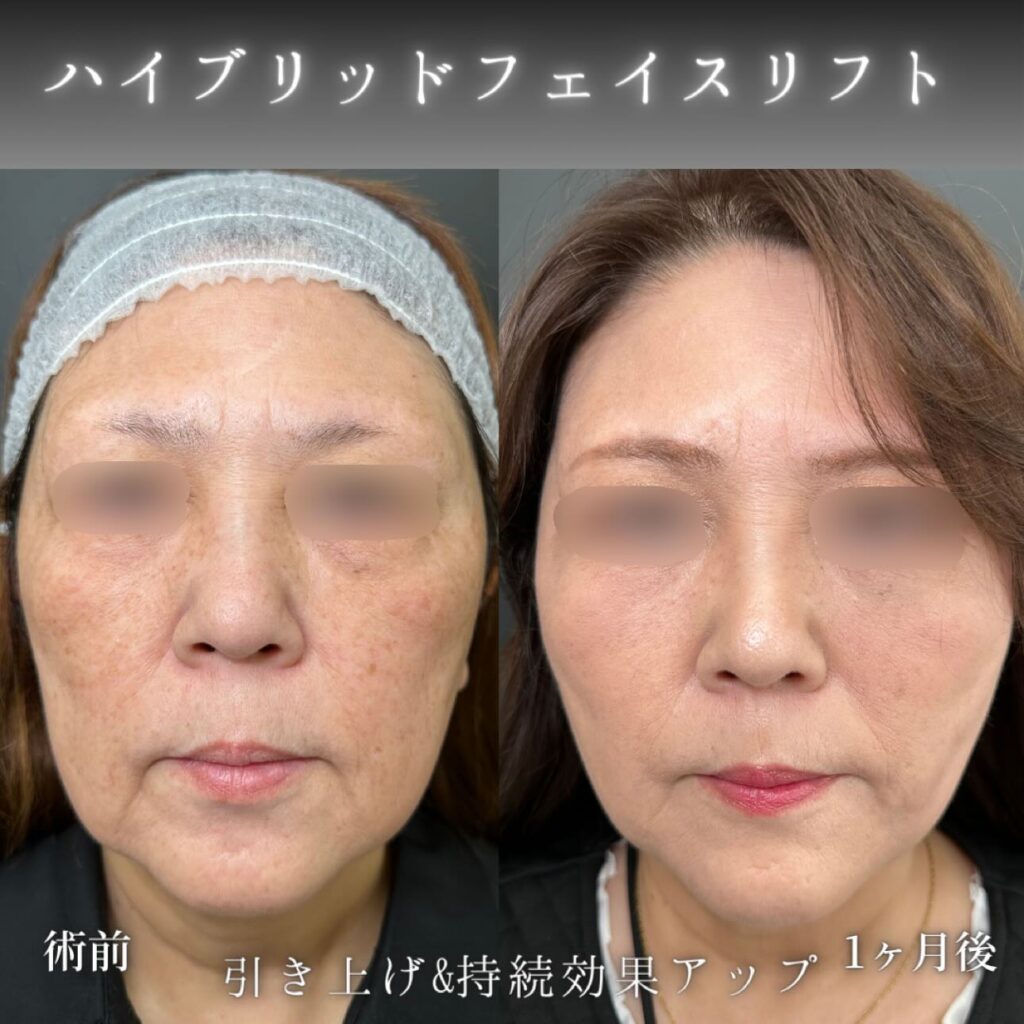 ハイブリッドフェイスリフトの症例写真 (1)