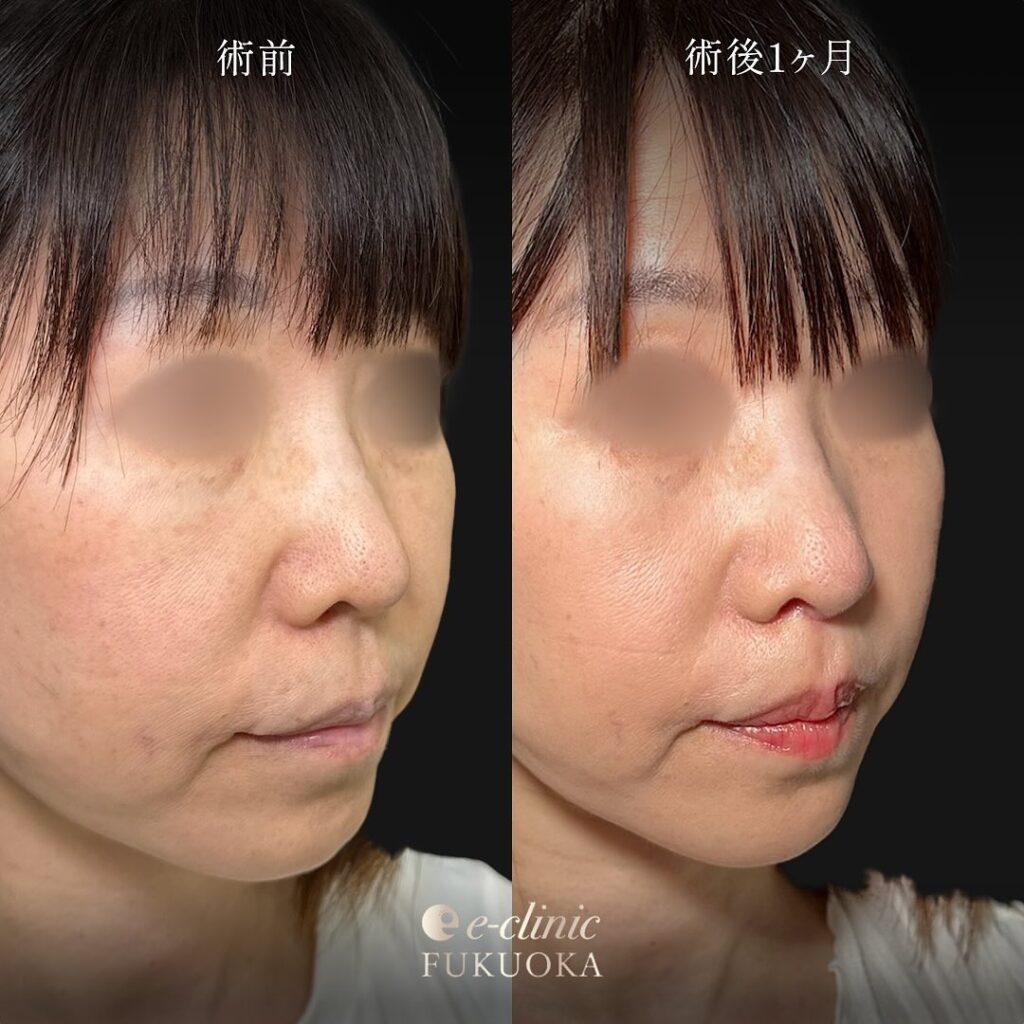 人中短縮の症例写真 (10)