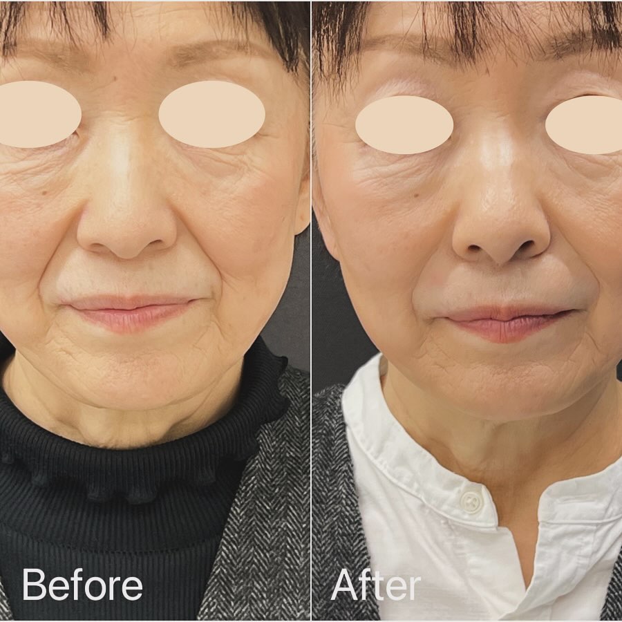 ほうれいの線ヒアルロン酸注入の症例写真 (2)