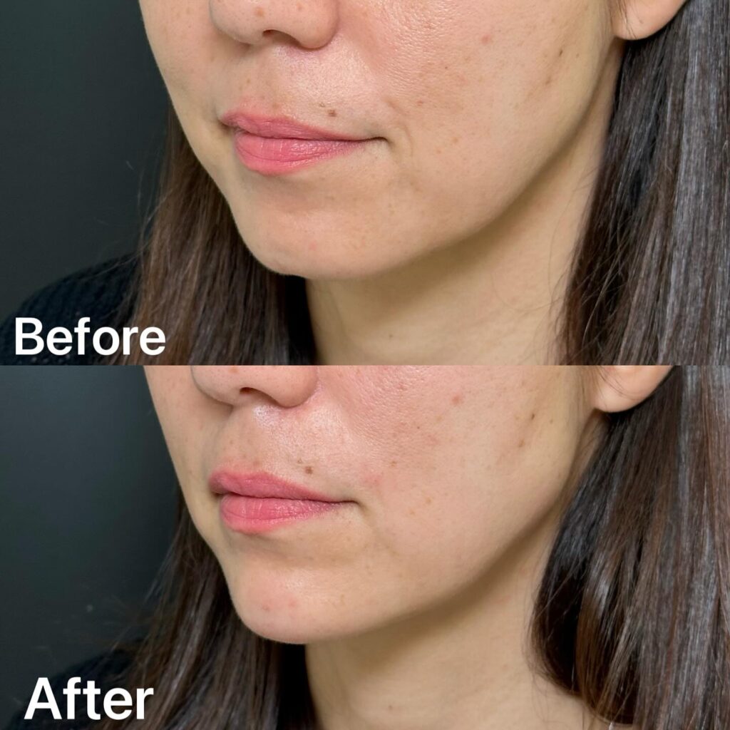 顎のヒアルロン酸の症例写真 (8)