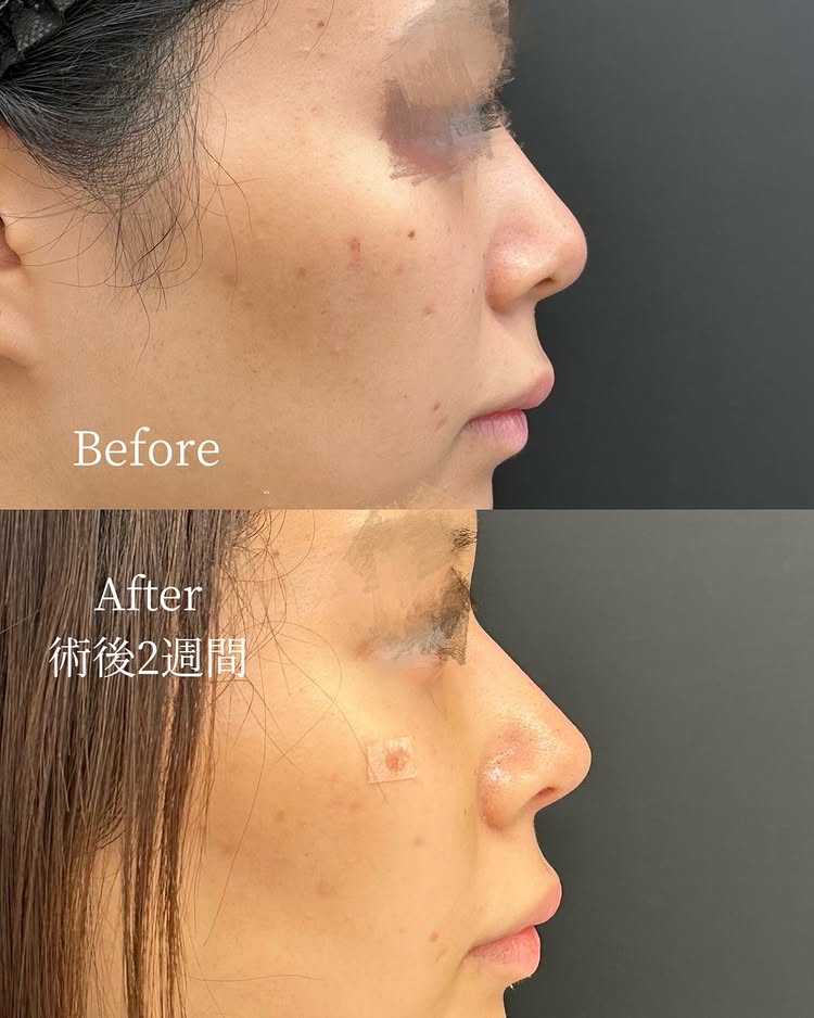 鼻尖形成と軟骨移植の症例写真 (10)