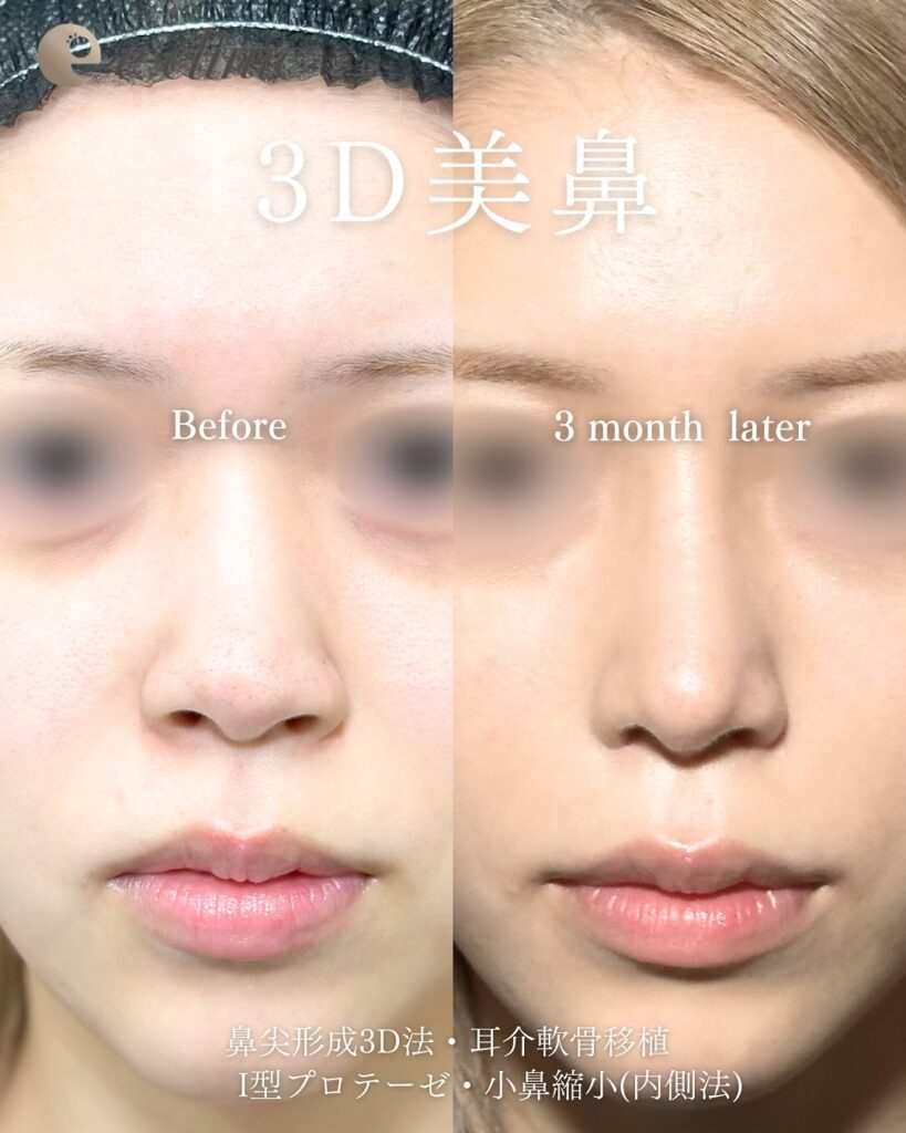 鼻尖形成と軟骨移植とプロテーゼと小鼻縮小の症例写真 (10)