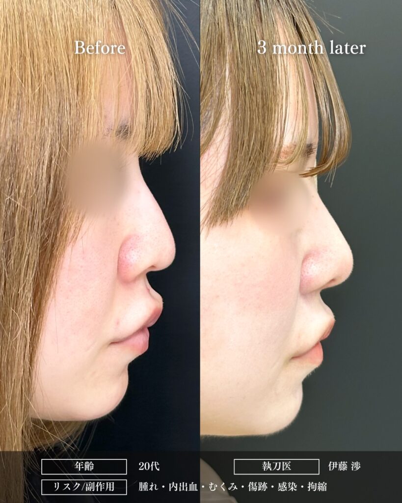 鼻尖形成と鼻中隔延長と耳介軟骨移植と小鼻縮小と鼻柱下降の症例写真 (3)