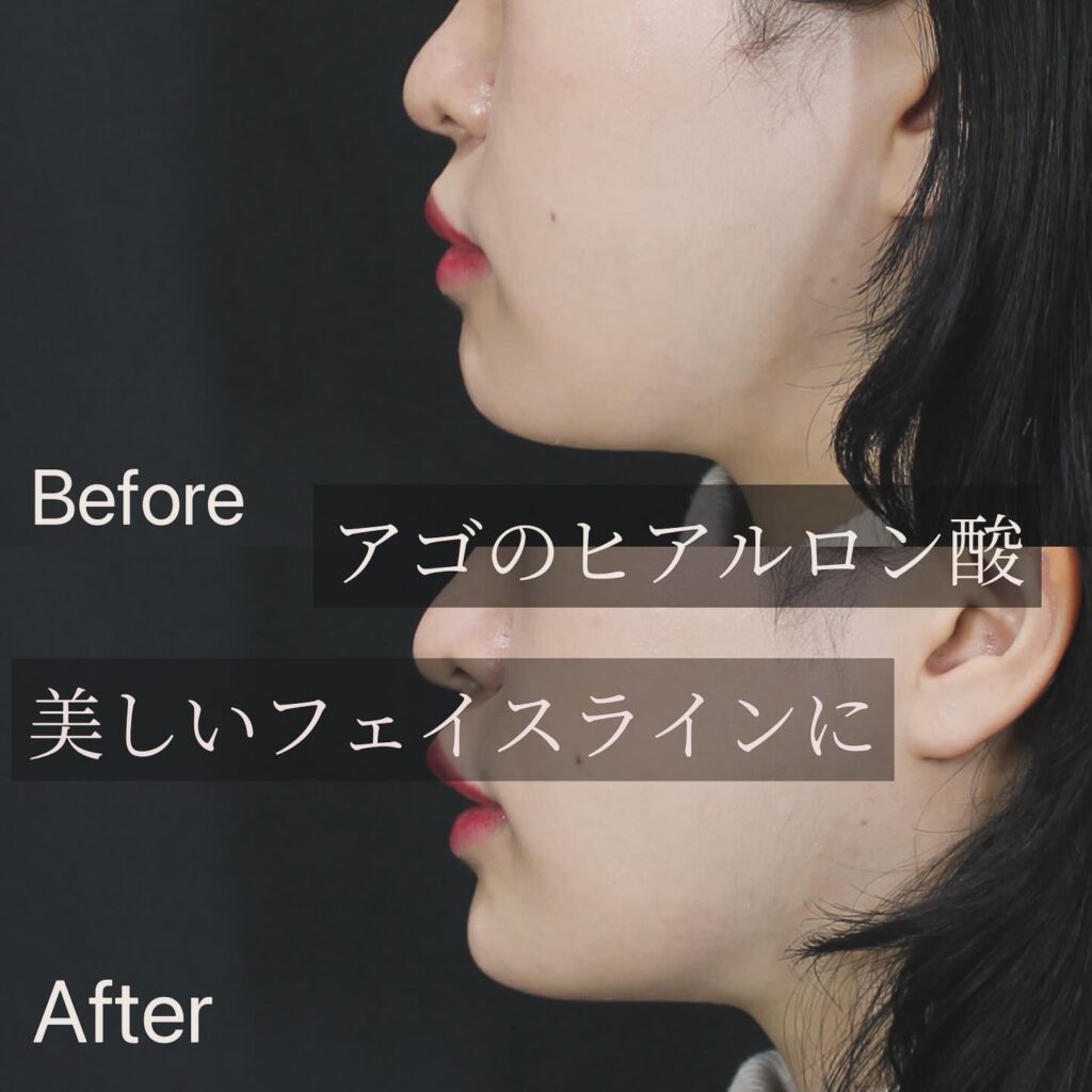 顎のヒアルロン酸の症例写真 (3)