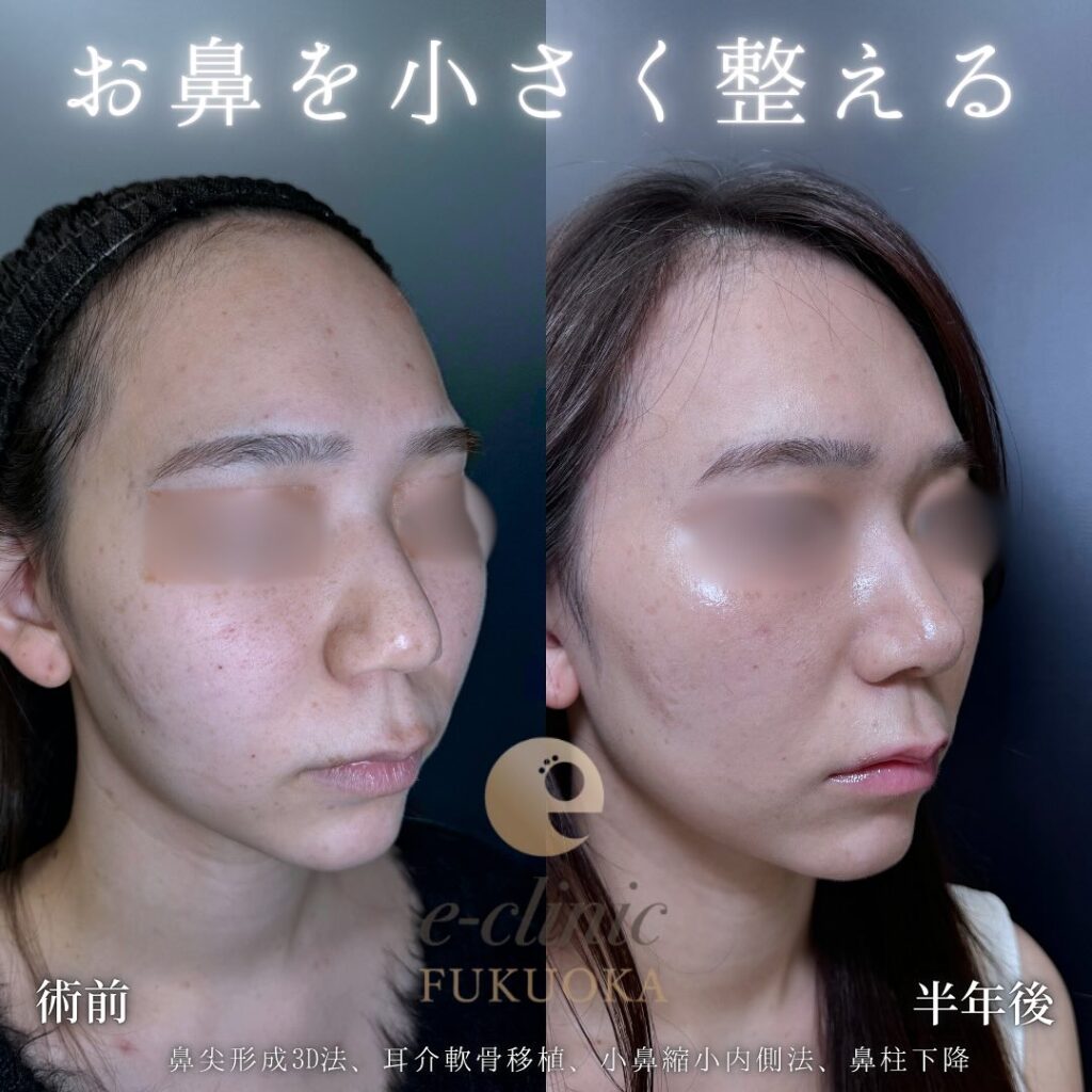 鼻尖形成と軟骨移植と小鼻縮小と小鼻縮小と鼻柱下降の症例写真 (2)