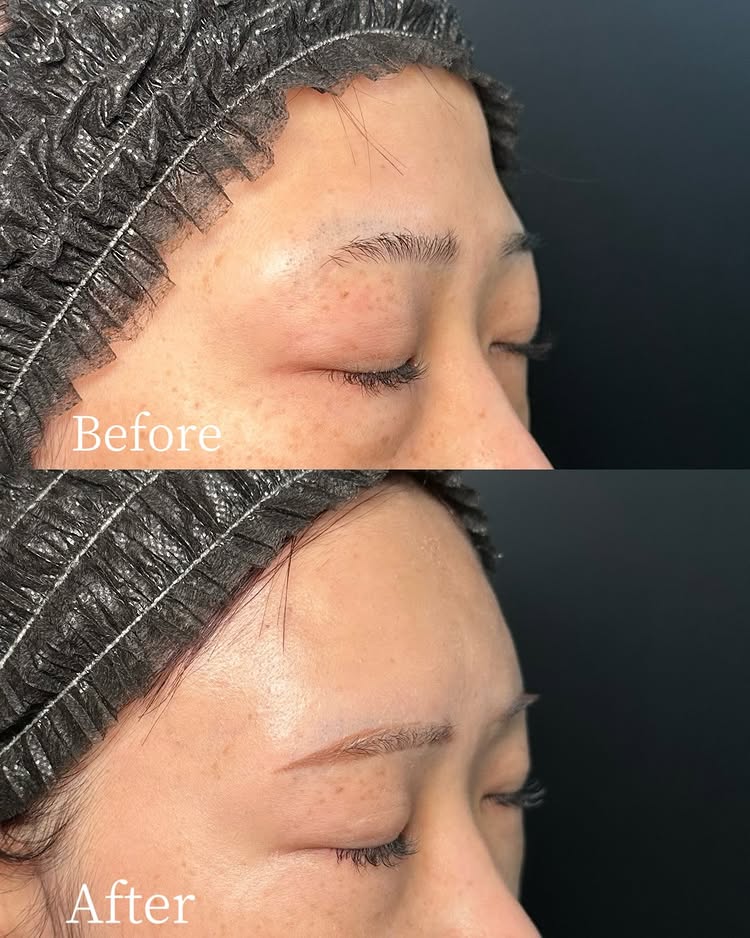 額のヒアルロン酸の症例写真 (2)