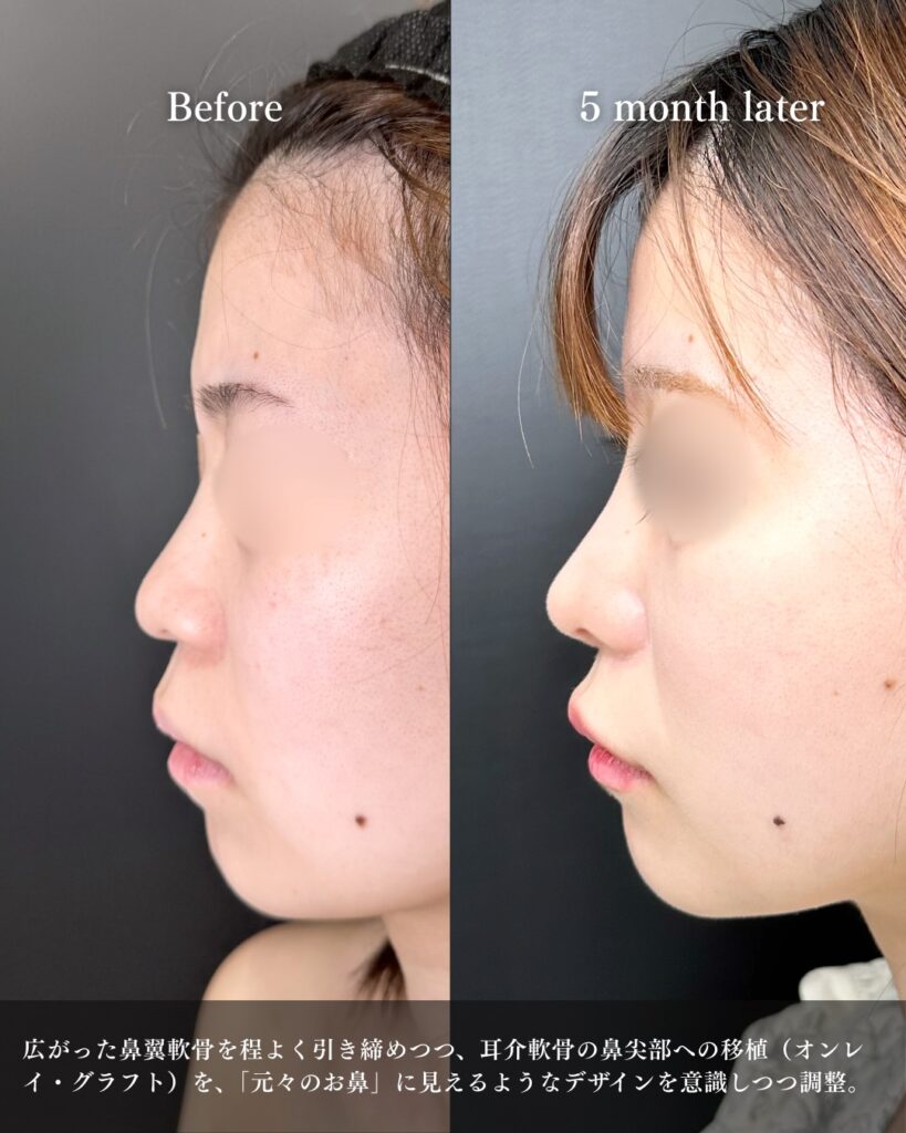 鼻尖形成と軟骨移植と鼻柱下降とプロテーゼの症例写真 (3)