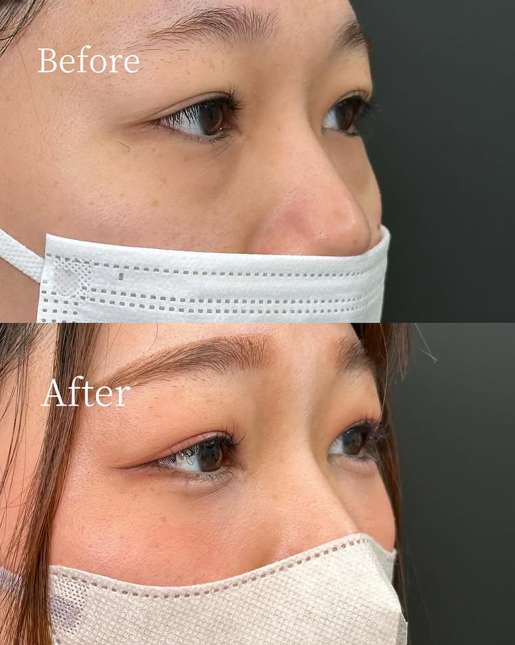 裏ハムラ法の症例写真 (56)