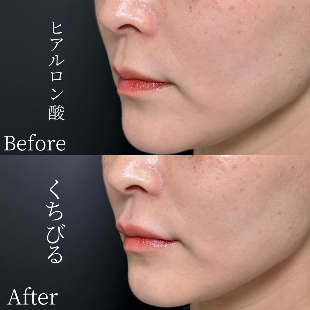 唇のヒアルロン酸の症例写真 (36)