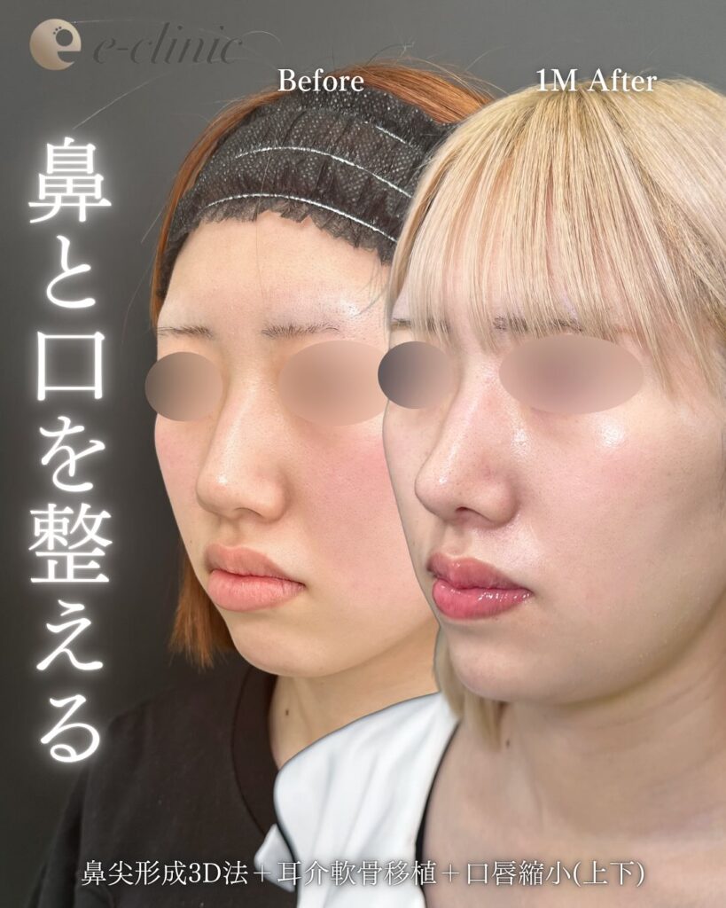 鼻尖形成と耳介軟骨移植と口唇縮小の症例写真 (3)