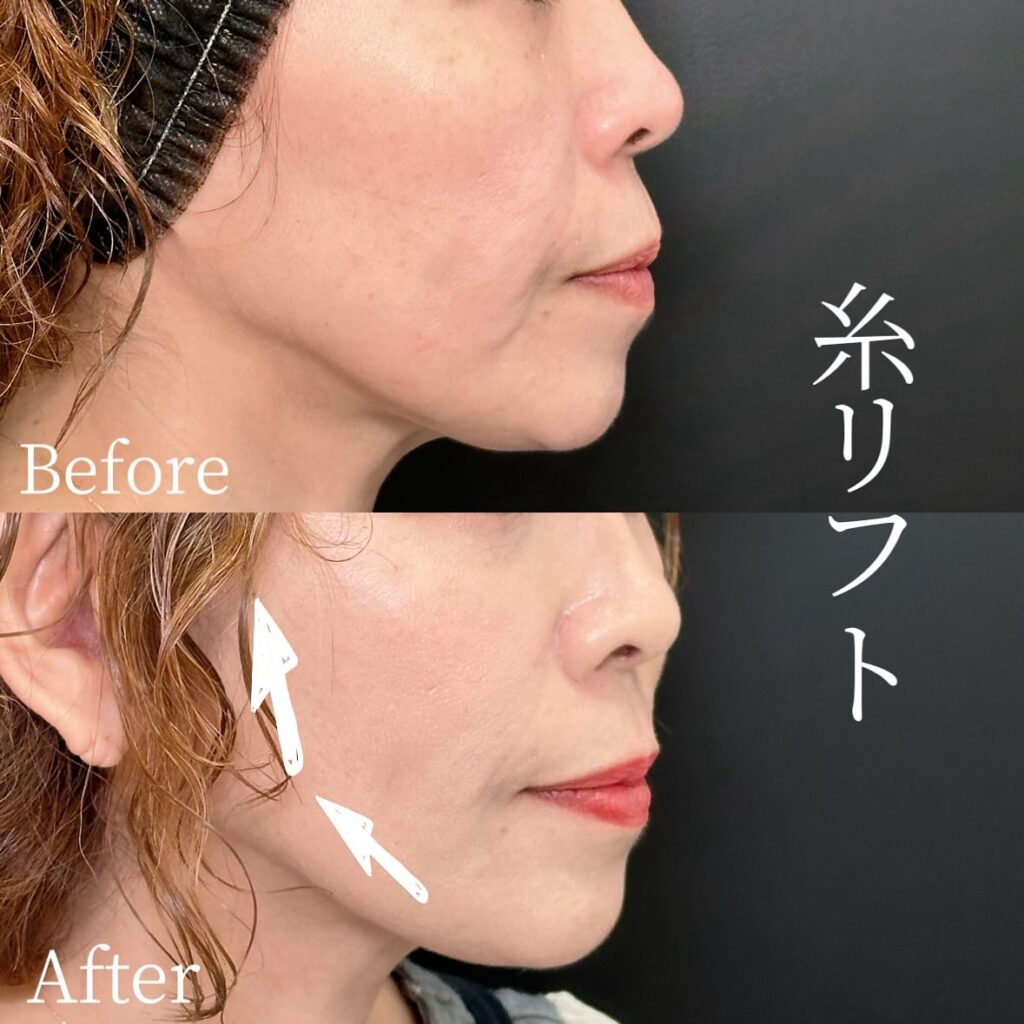 糸リフトの症例写真 (33)