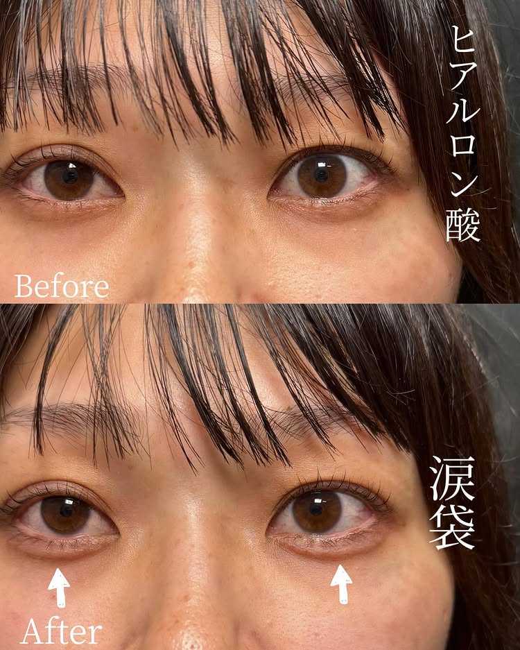 涙袋のヒアルロン酸の症例写真 (10)