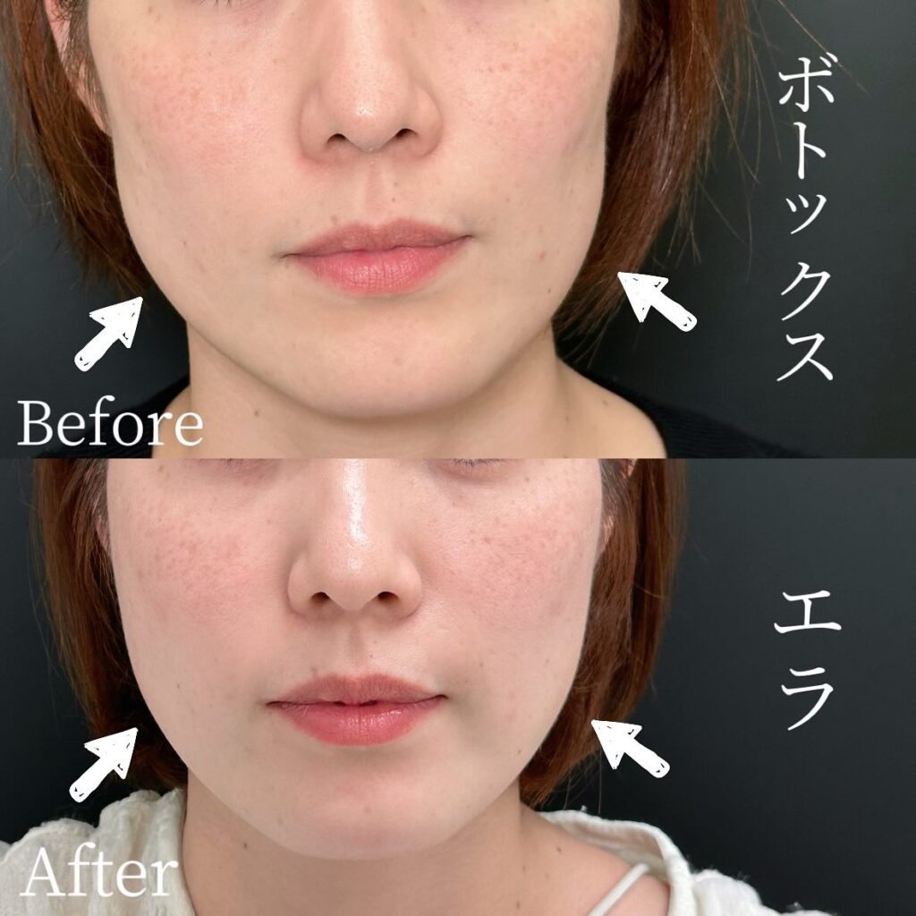 エラボトックスの症例写真 (2)