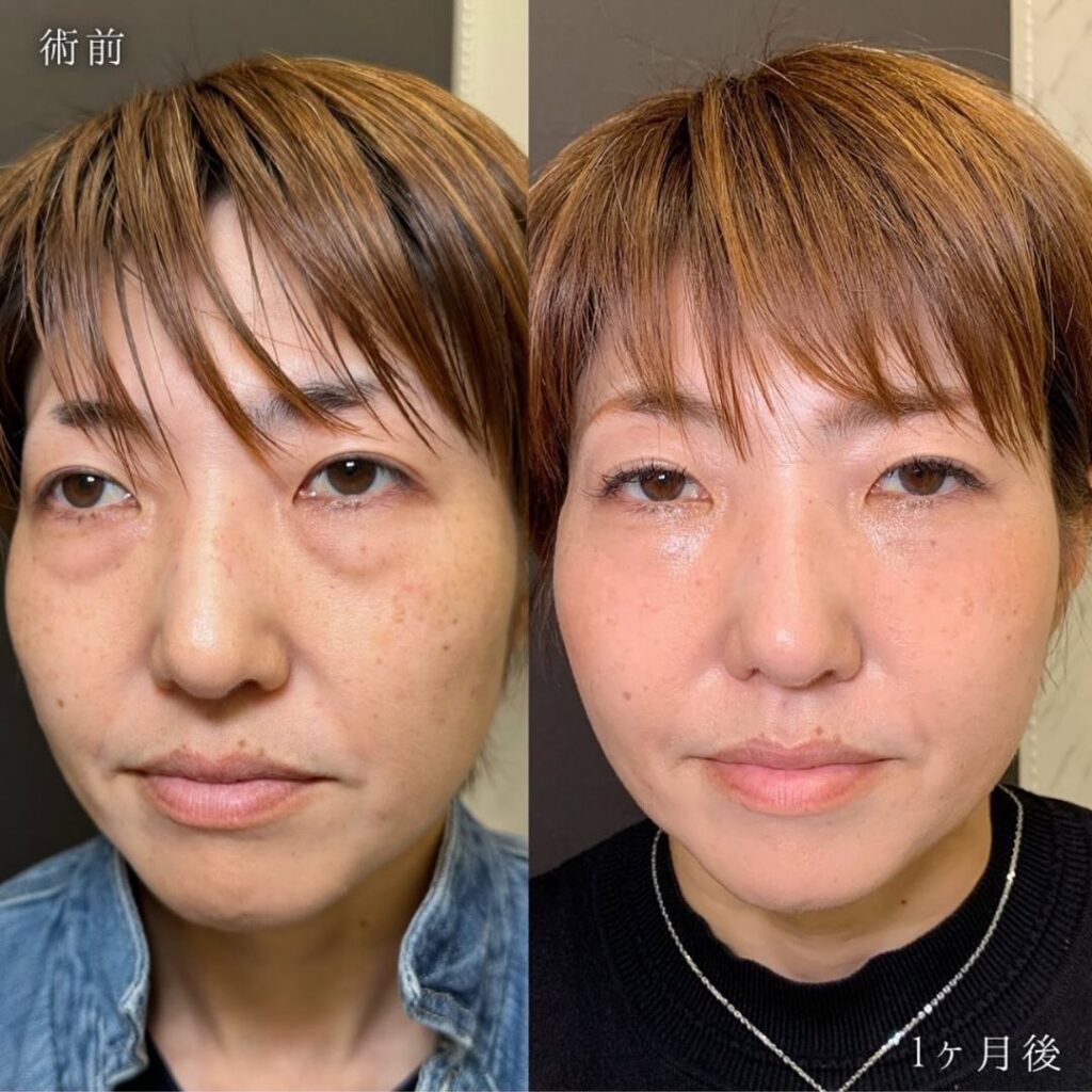 糸リフトと裏ハムラ法と脂肪注入の症例写真 (2)