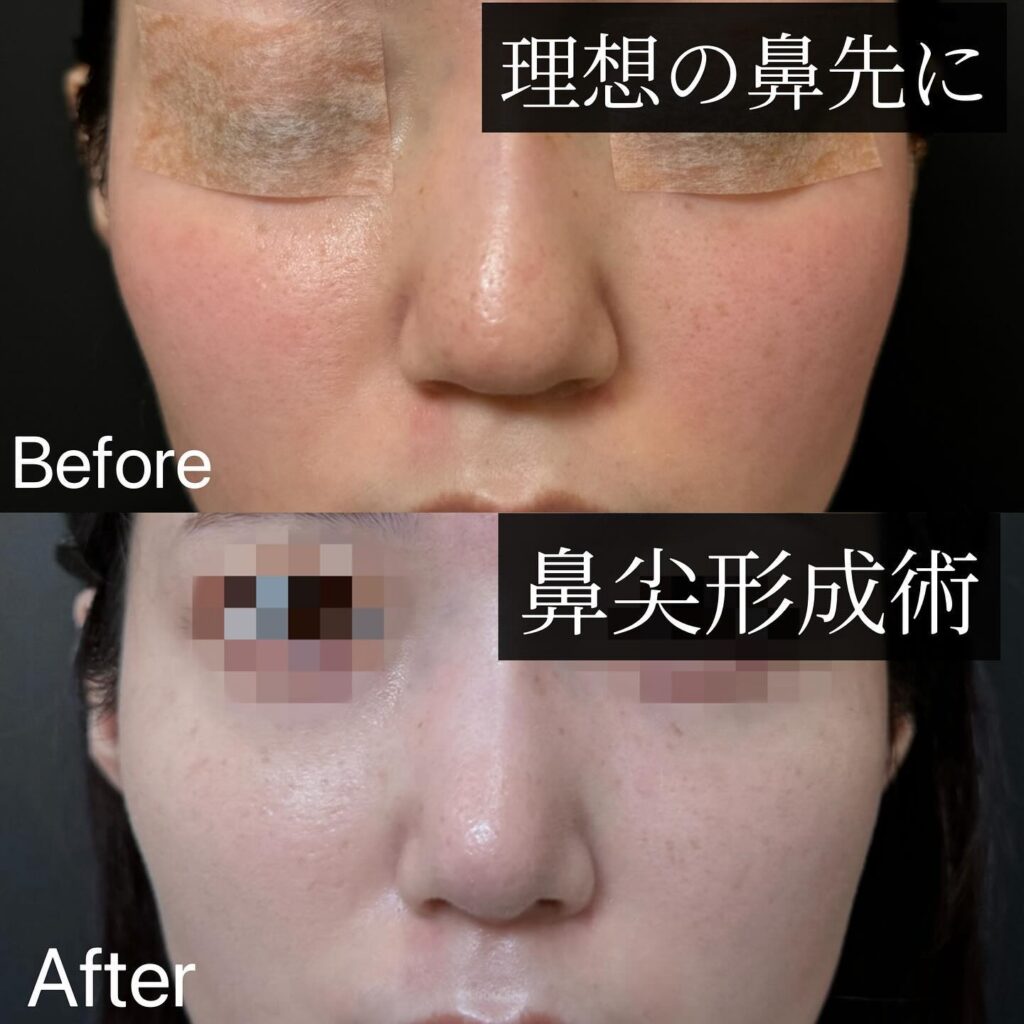 鼻尖形成と軟骨移植の症例写真 (1)