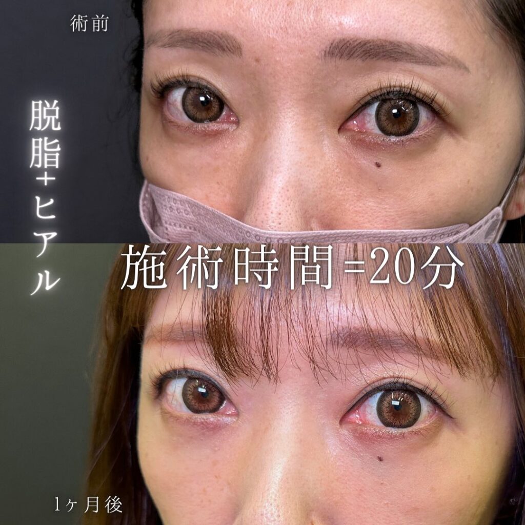 脱脂と目の下のヒアルロン酸の症例写真 (3)