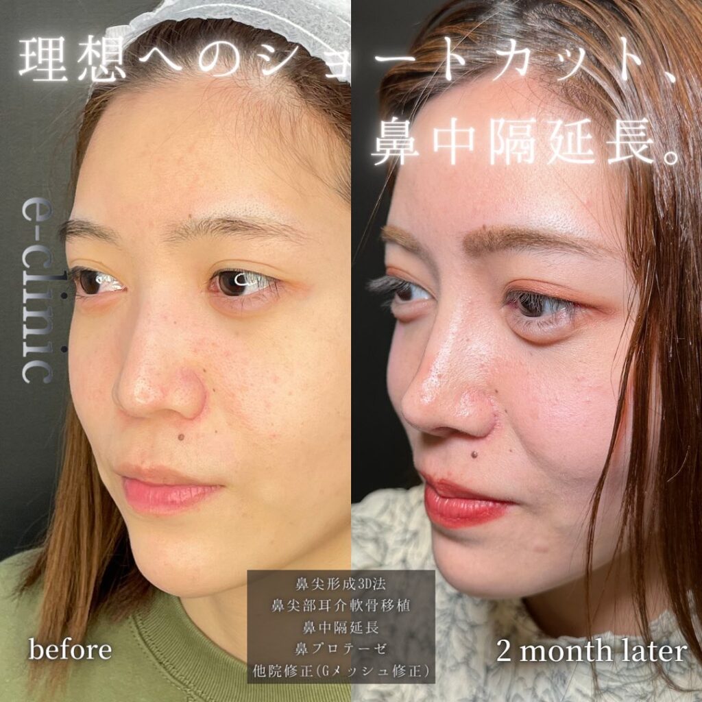 鼻中隔延長と鼻尖形成と耳介軟骨移植とプロテーゼと他院修正の症例写真 (7)
