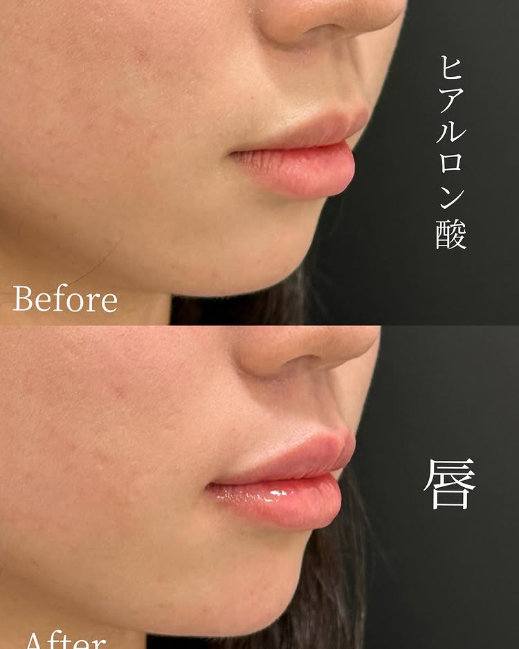唇のヒアルロン酸の症例写真 (44)