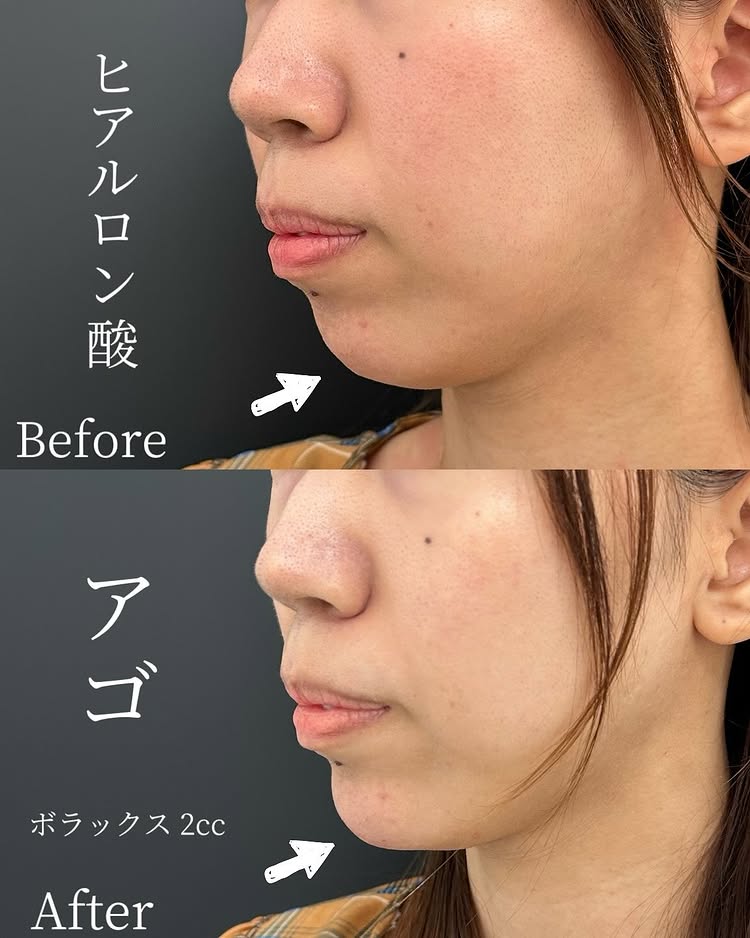 顎のヒアルロン酸の症例写真 (33)