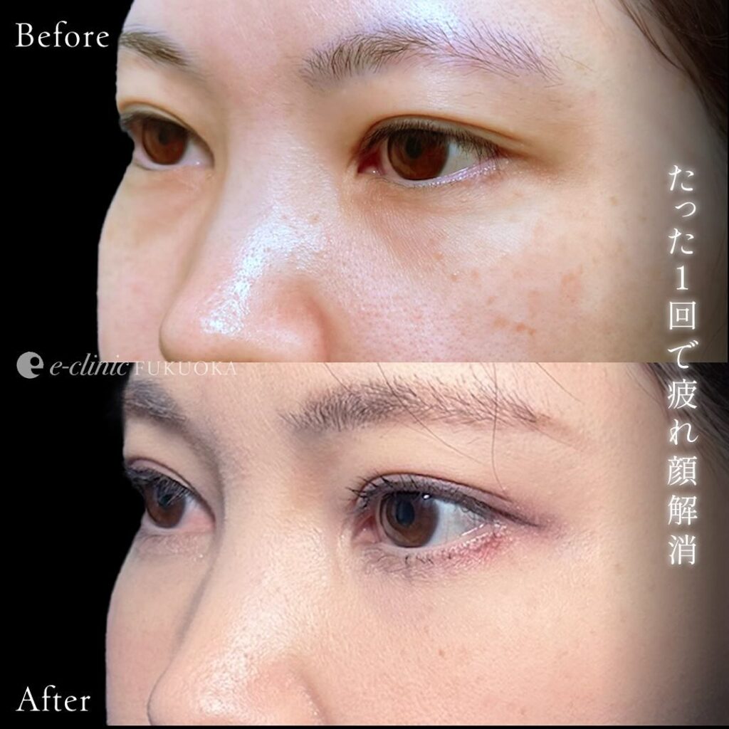 裏ハムラ法とナノリッチの症例写真 (11)