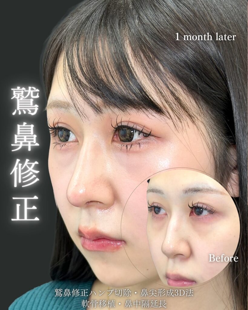 鼻中隔延長と鼻尖形成と軟骨移植と鷲鼻修正の症例写真 (1)