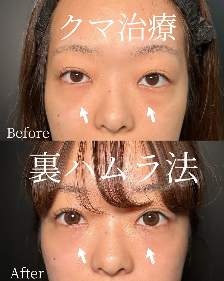 裏ハムラ法の症例写真 (89)