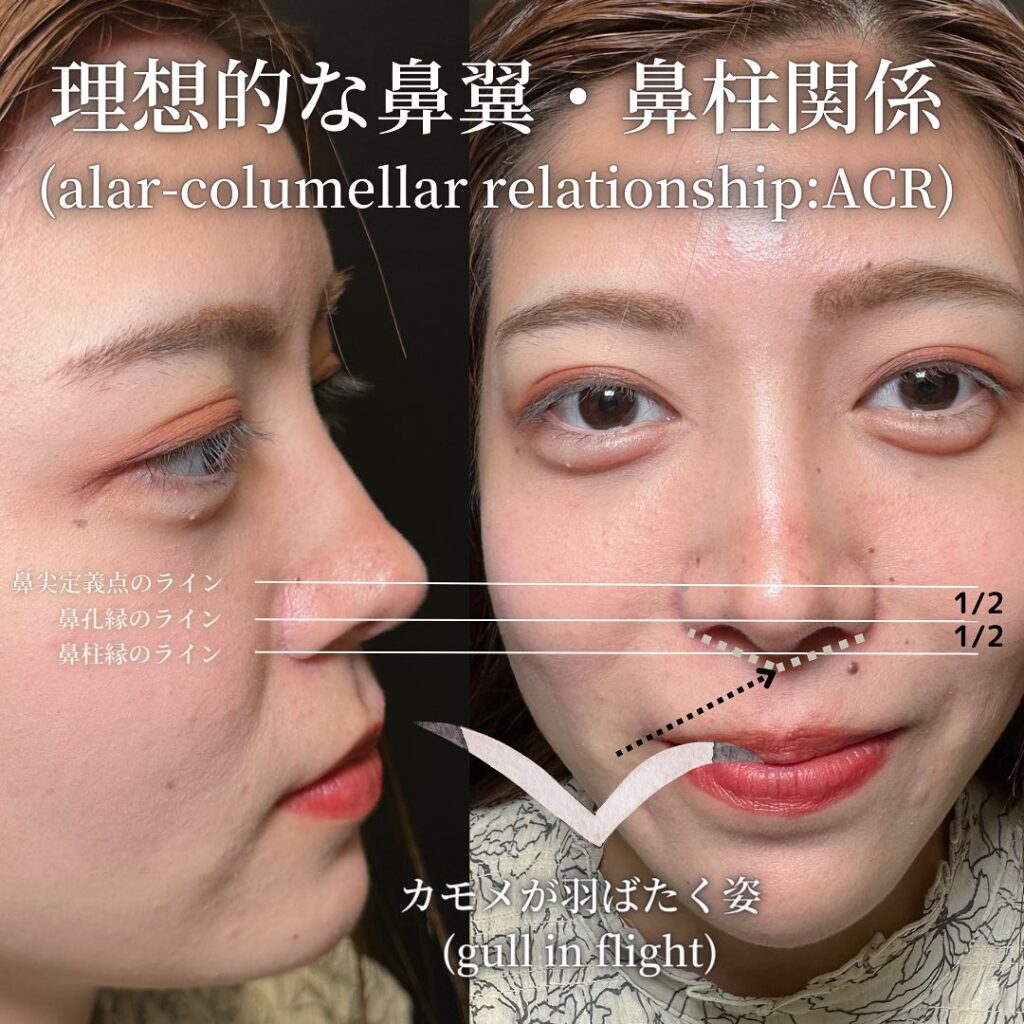 鼻中隔延長と鼻尖形成と耳介軟骨移植とプロテーゼと他院修正の症例写真 (6)