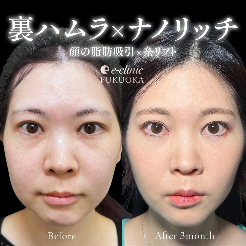 裏ハムラ法とナノリッチの症例写真 (10)