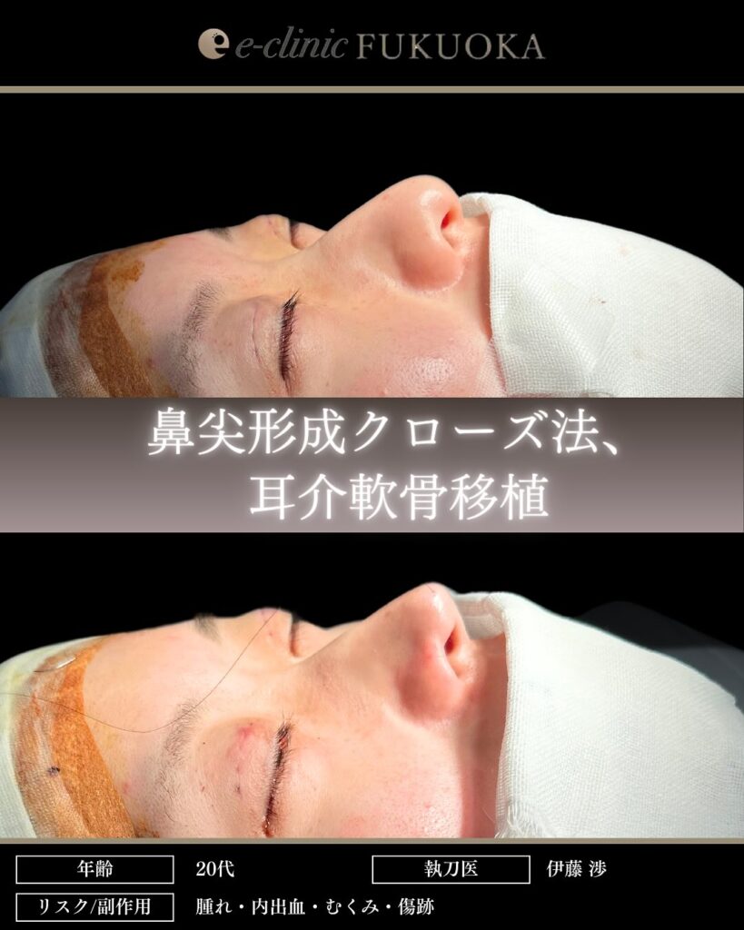 鼻尖形成と軟骨移植の症例写真 (16)