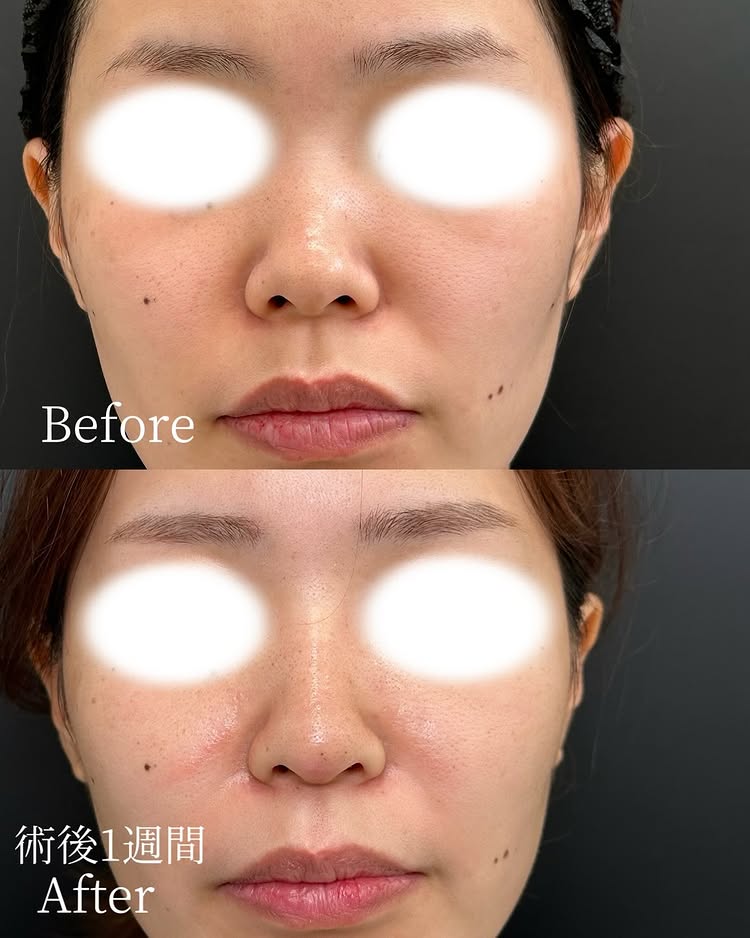 鼻尖形成と軟骨移植の症例写真 (16)