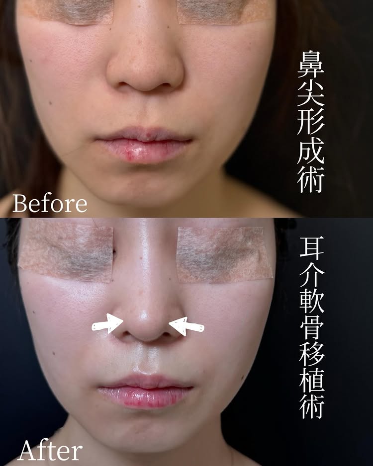 鼻尖形成と軟骨移植の症例写真 (8)