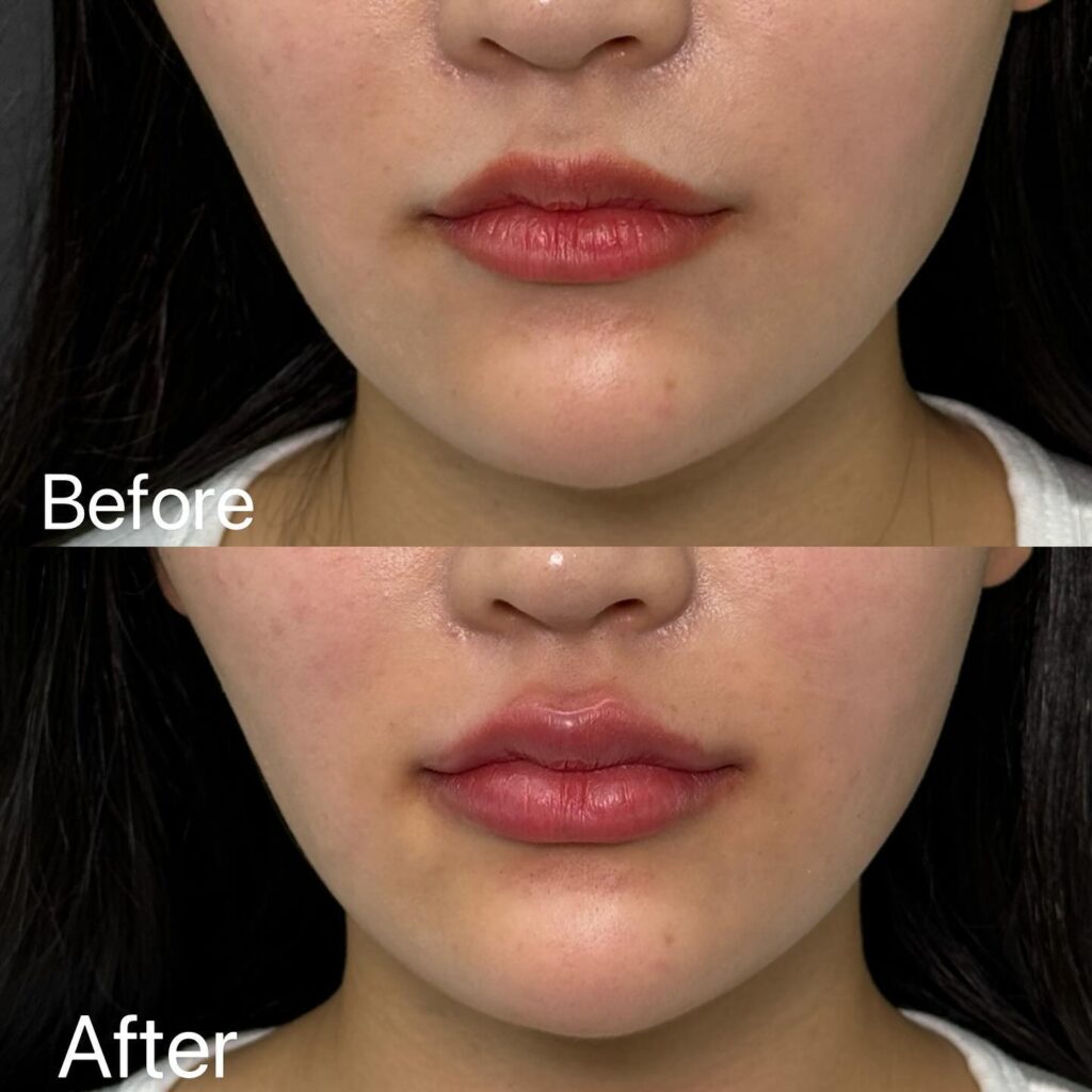 唇のヒアルロン酸の症例写真 (23)