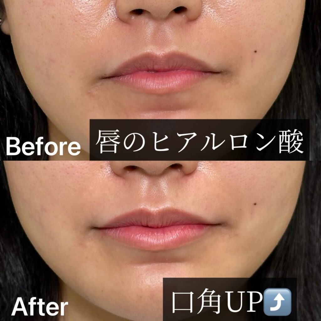 唇のヒアルロン酸の症例写真 (26)