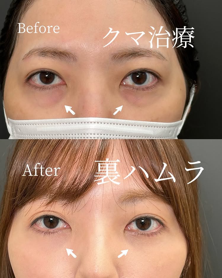 裏ハムラ法の症例写真 (70)