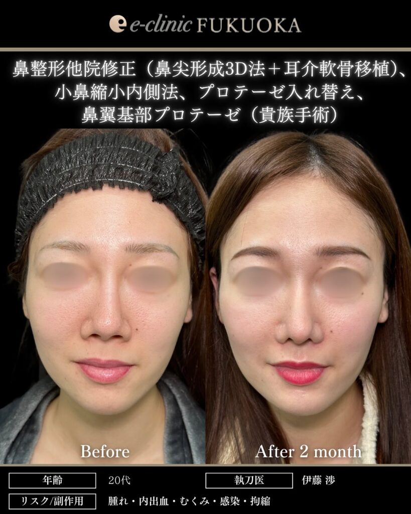 鼻尖形成と軟骨移植と小鼻縮小とプロテーゼと貴族手術の症例写真 (1)